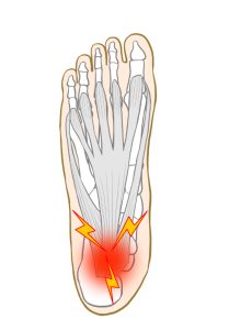 足底腱膜炎の痛み