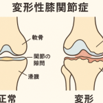 変形性膝関節症