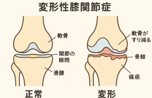 変形性膝関節症