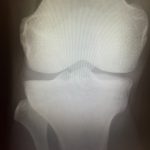 整形外科で膝のレントゲンを確認する医師と患者のイメージ