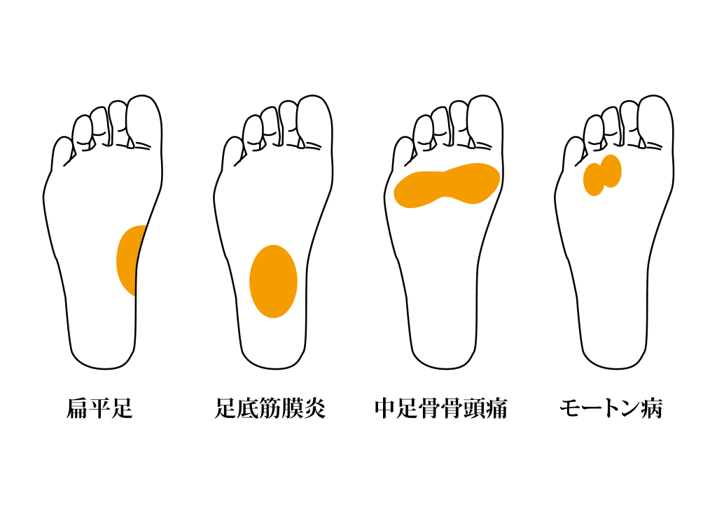 モートン病が起こりやすい足の神経の位置図