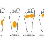 モートン病が起こりやすい足の神経の位置図