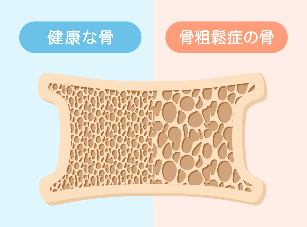 骨粗しょう症