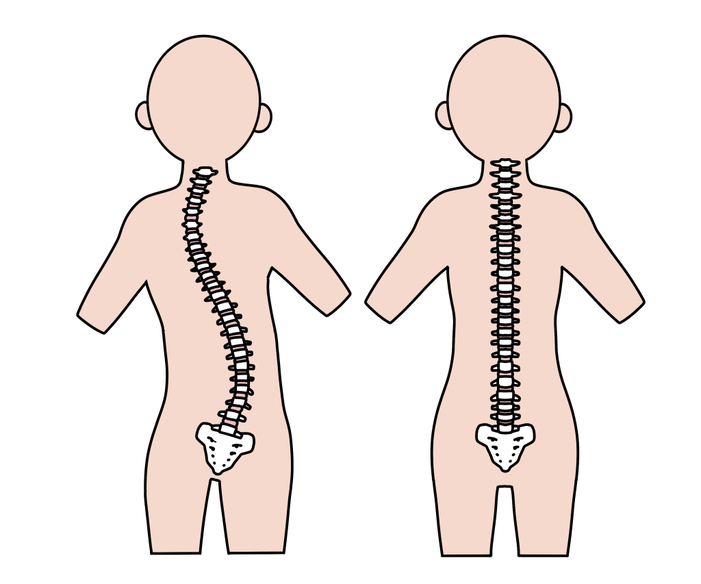 正常な背骨と側湾症の背骨の比較イラスト