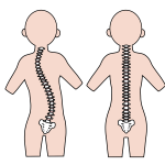 正常な背骨と側湾症の背骨の比較イラスト