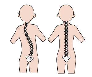 正常な背骨と側湾症の背骨の比較イラスト