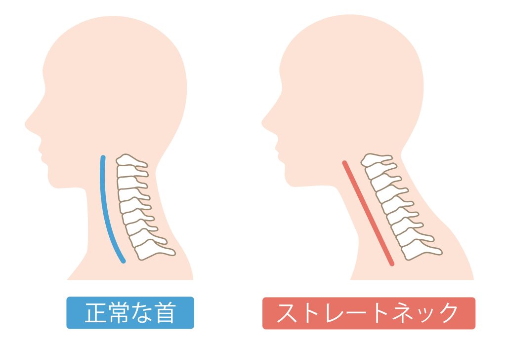 正常な頸椎カーブとストレートネックの比較図