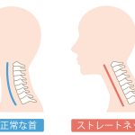 正常な頸椎カーブとストレートネックの比較図