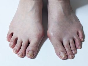 正常な足と外反母趾の足の違いがわかる比較画像