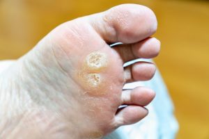 魚の目（鶏眼）とたこの違いを示す足裏の図解