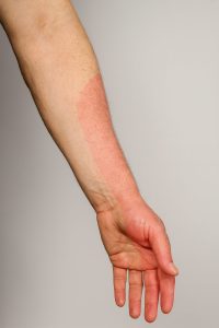 右上肢の実写風画像。橈骨神経の知覚支配領域がピンクで示されている。